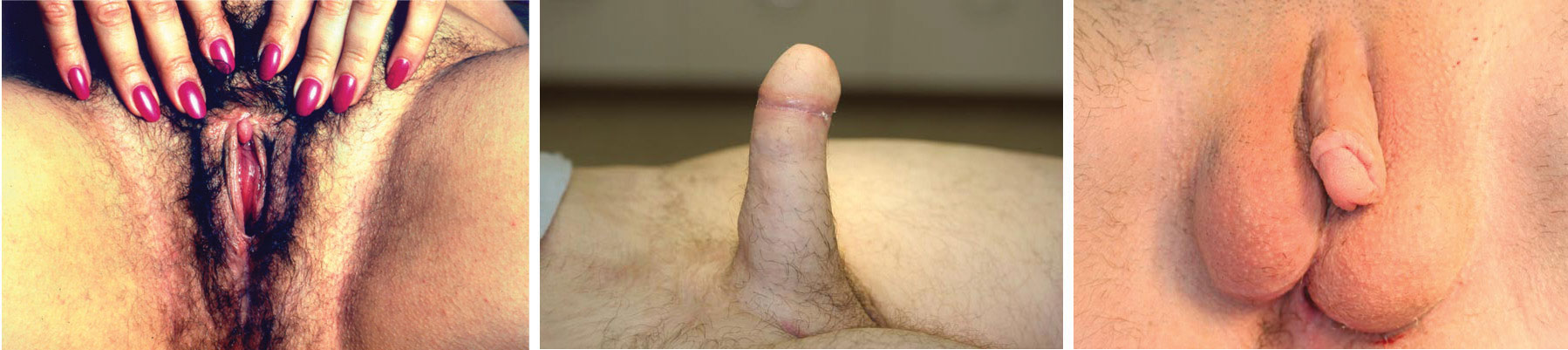 Clitoris After Testosterone Treatment.