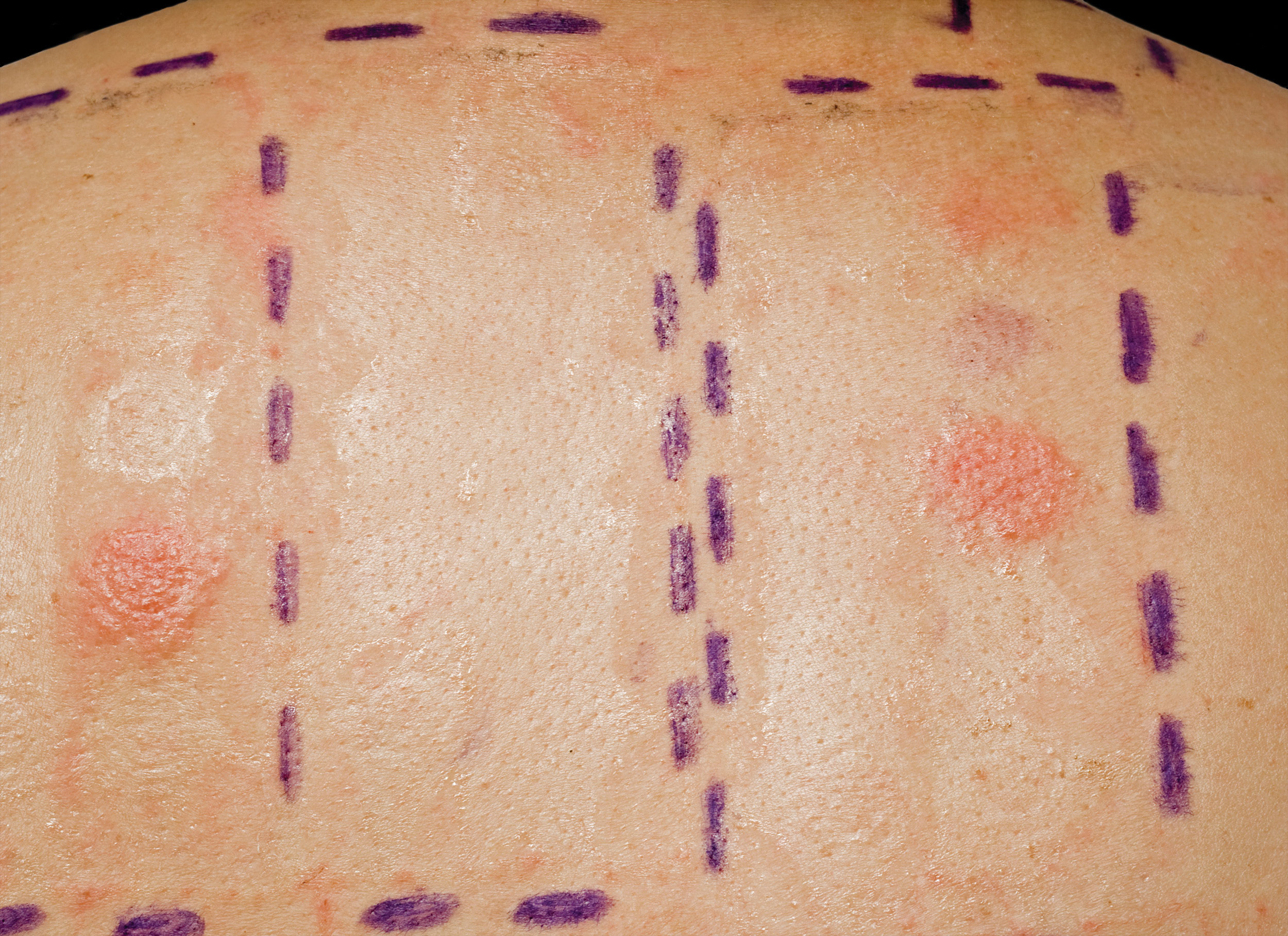 This image shows patches of redness and swelling after an allergy skin patch test, one of the common diagnostic tests to identify allergens.